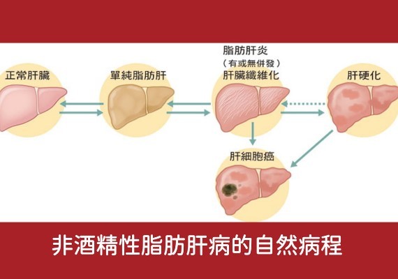 脂肪肝